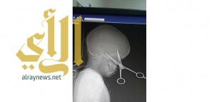 استخراج “مقص” اخترق جمجمة طفل في جدة