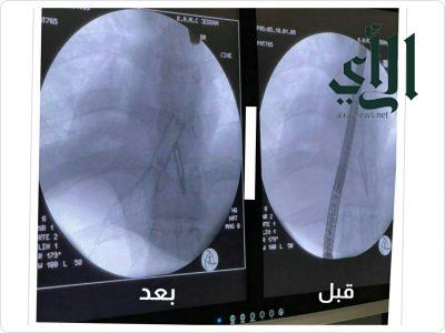 تركيب دعامة حديدية لمريض يعاني من ناسور في المرئ بمجمع #الملك_عبد الله الطبي بـ #جدة