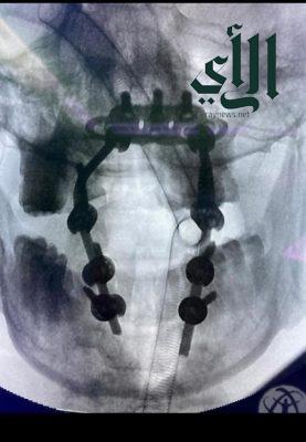 صحة بيشة: جراحة ناجحة تنقذ مصاب من شلل رباعي بمستشفى الملك عبدالله