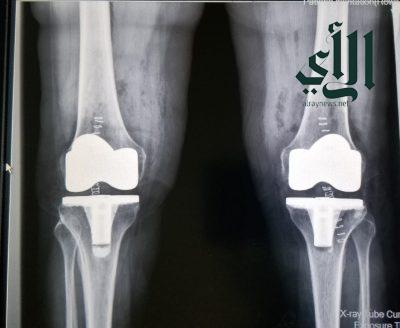 مستشفى #حريملاء العام يُنهي معاناة مريضة من احتكاك وخشونة بالركبة