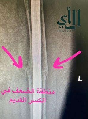 تبديل مفصل الورك لمريضة تعاني هشاشة العظام بمستشفى الملك عبدالعزيز بالطائف