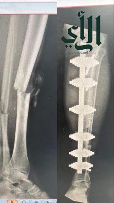 إنقاذ ساق مقيم من البتر في مستشفى الملك خالد بالخرج