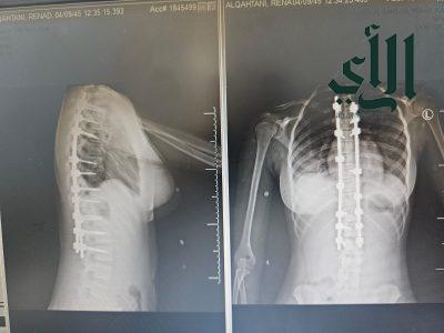 بيشة: جراحة ناجحة لطفلة تعاني من “الجنف” بمستشفى الملك عبدالله