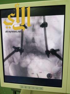 الصحة : نجاح عملية تثبيت للعمود الفقري بدون شق جراحي بمستشفى الملك فهد بالمدينة المنورة