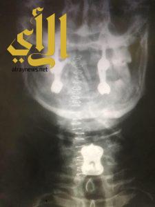 جراحة دقيقة لإنقاذ مريض من شلل رباعي في مستشفى الملك فهد بالباحة